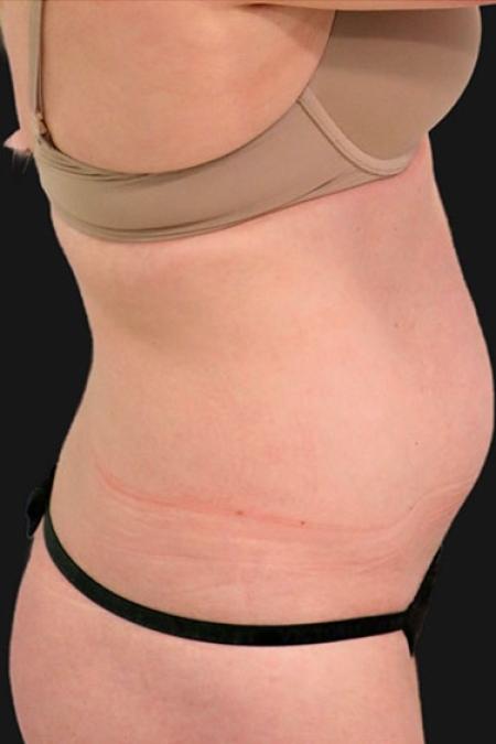 Before Case #116306 - 32 year old patient | Tummy Tuck