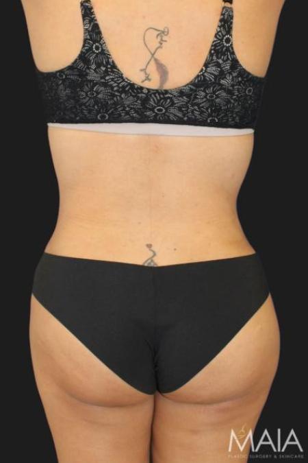 After image 2 Case #116296 - 47 year old patient | Tummy Tuck