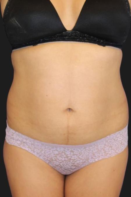 Before image 1 Case #116296 - 47 year old patient | Tummy Tuck