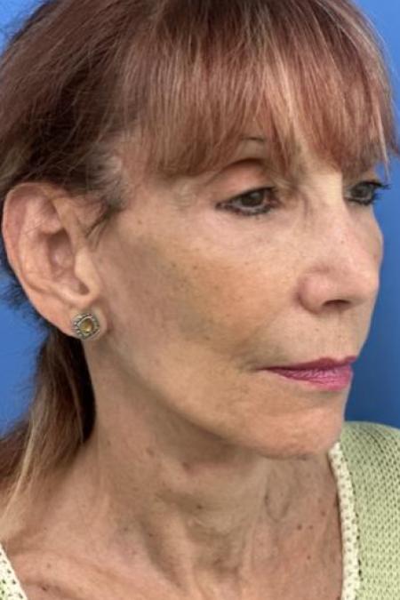 After image 2 Case #116231 - 72 year old  -  Facelift  - 3 month post-op