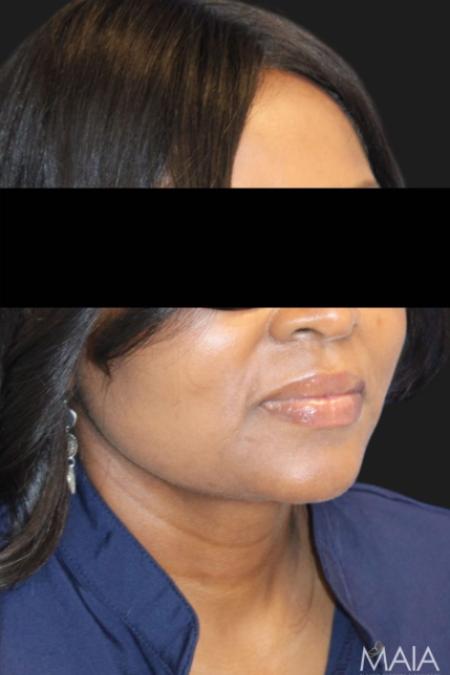 After image 1 Case #119176 - 50 year-old Patient | Neck Lift