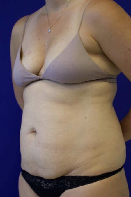 Before Case #119306 - 41 year-old Patient | Tummy Tuck