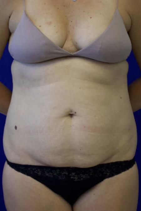 Before Case #119306 - 41 year-old Patient | Tummy Tuck
