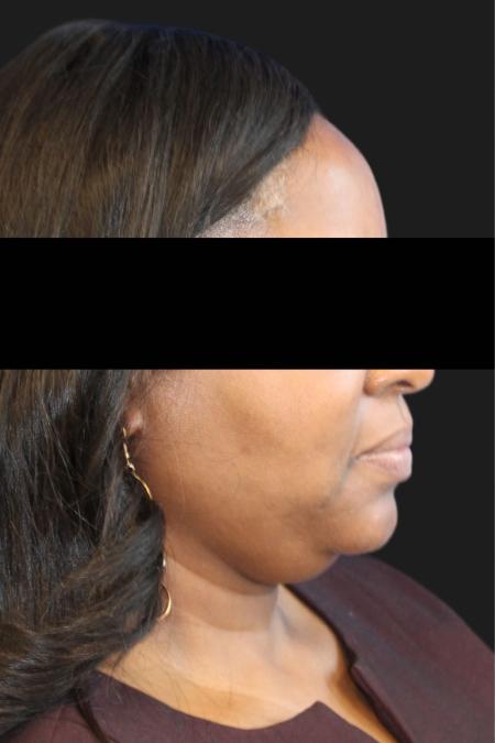 Before image 3 Case #119176 - 50 year-old Patient | Neck Lift