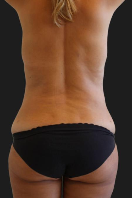Before image 4 Case #119276 - 48 year-old Patient | Tummy Tuck
