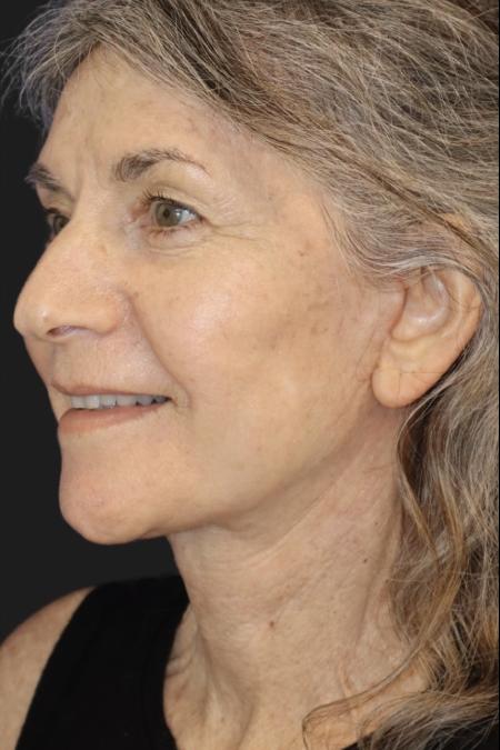 After image 1 Case #119161 - 65 year-old Patient | Neck Lift