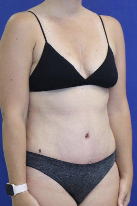After Case #119306 - 41 year-old Patient | Tummy Tuck