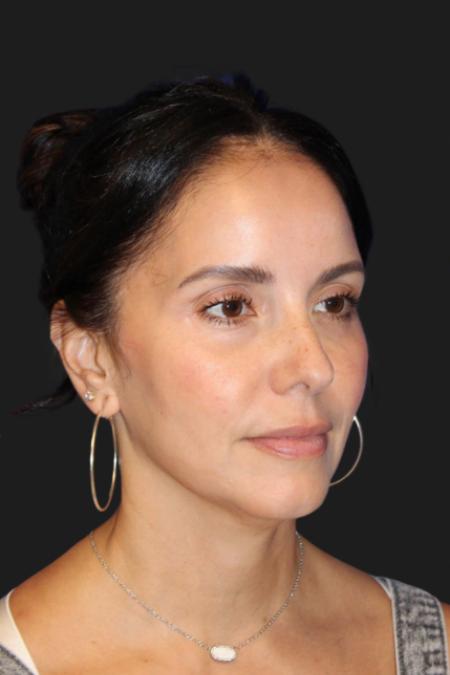 Before image 1 Case #119231 - 49 year-old Patient | Mini Facelift 