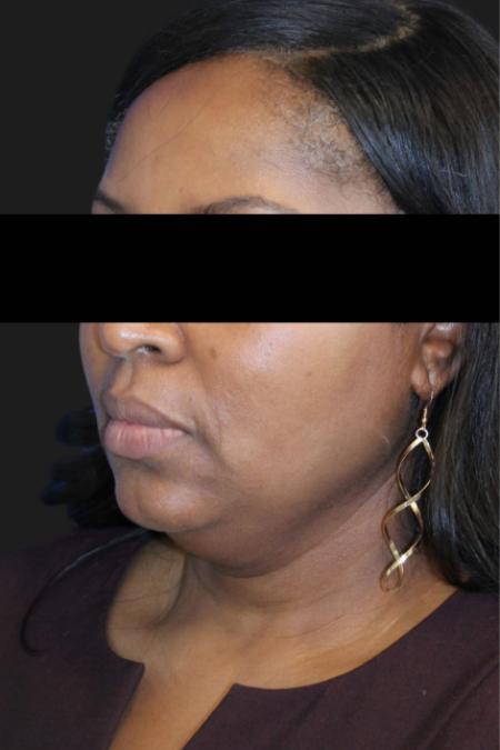 Before image 2 Case #119176 - 50 year-old Patient | Neck Lift