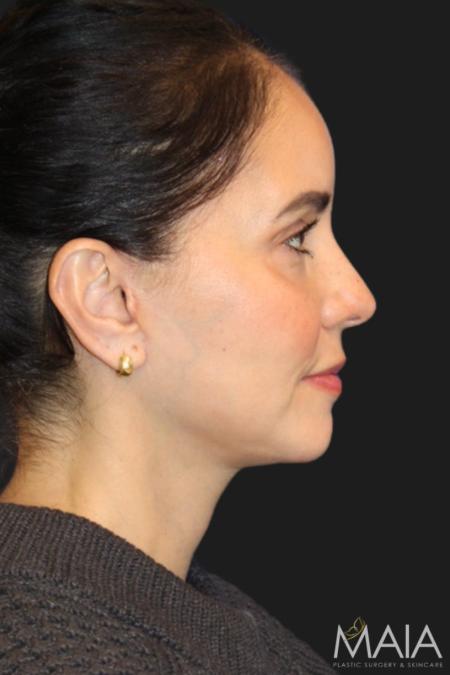 After image 4 Case #119231 - 49 year-old Patient | Mini Facelift 