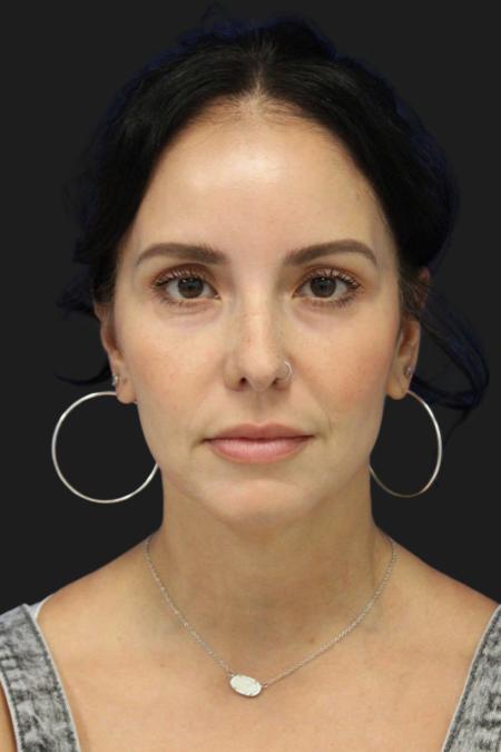 Before image 2 Case #119231 - 49 year-old Patient | Mini Facelift 