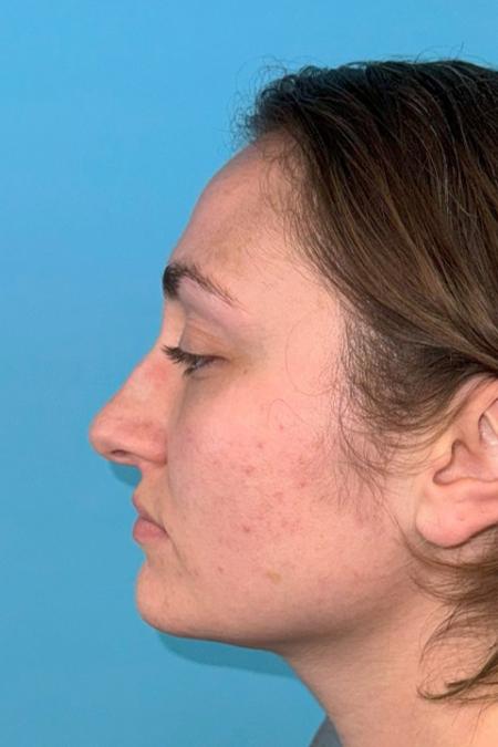 Before image 3 Case #119166 - Dream nose!