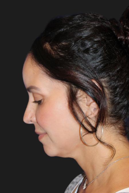 Before image 3 Case #119231 - 49 year-old Patient | Mini Facelift 