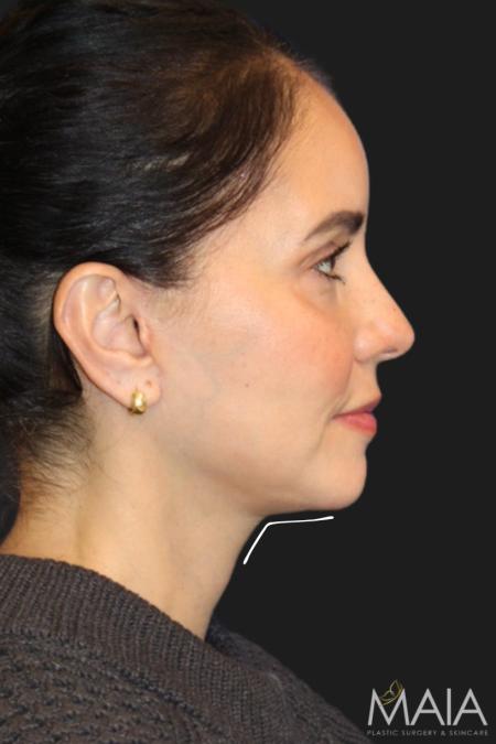 After image 5 Case #119231 - 49 year-old Patient | Mini Facelift 