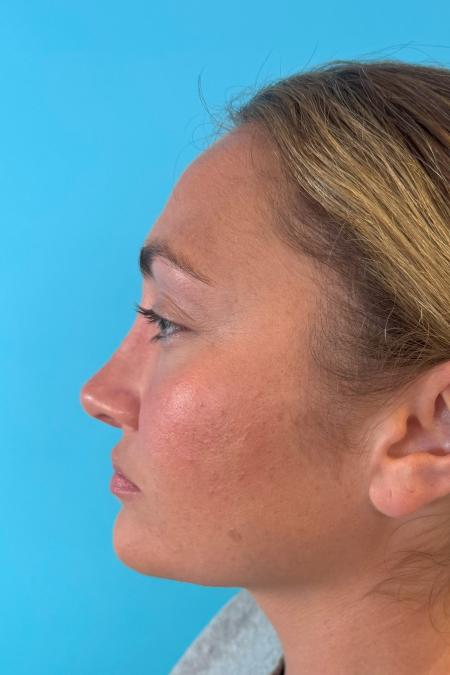 After image 3 Case #119166 - Dream nose!