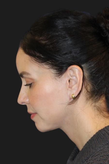 After image 3 Case #119231 - 49 year-old Patient | Mini Facelift 