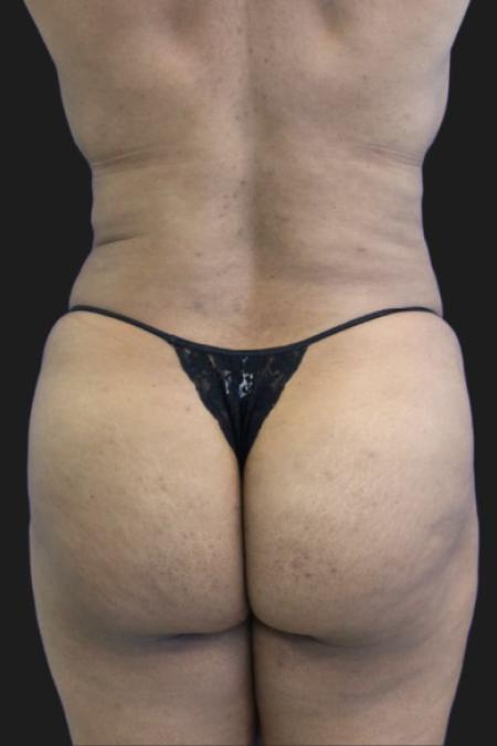 Before image 4 Case #119291 - 46 year-old Patient | Tummy Tuck