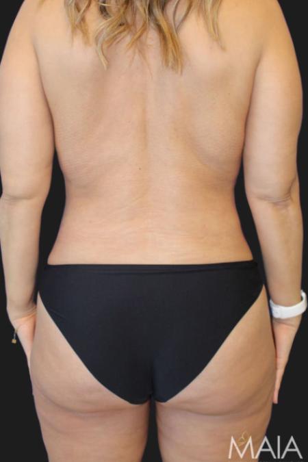 After image 5 Case #119276 - 48 year-old Patient | Tummy Tuck