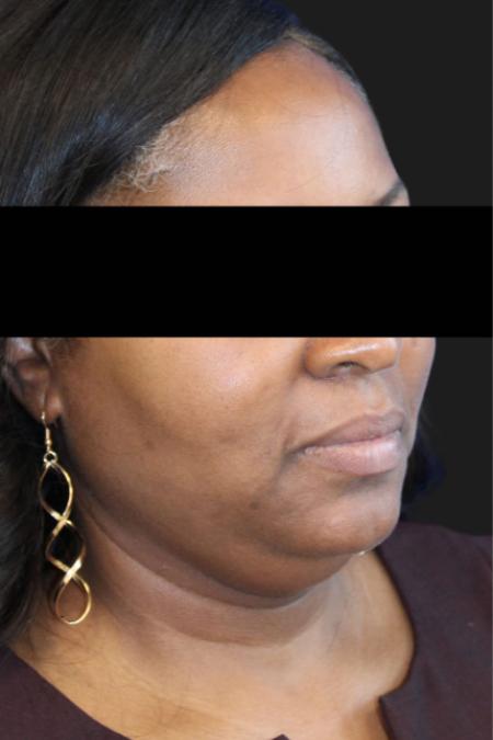 Before image 1 Case #119176 - 50 year-old Patient | Neck Lift