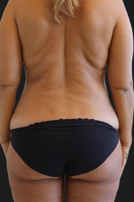 Before image 5 Case #119276 - 48 year-old Patient | Tummy Tuck