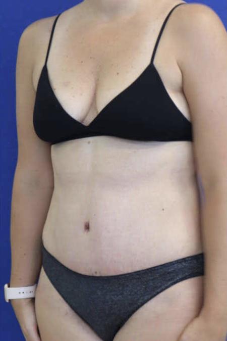 After Case #119306 - 41 year-old Patient | Tummy Tuck