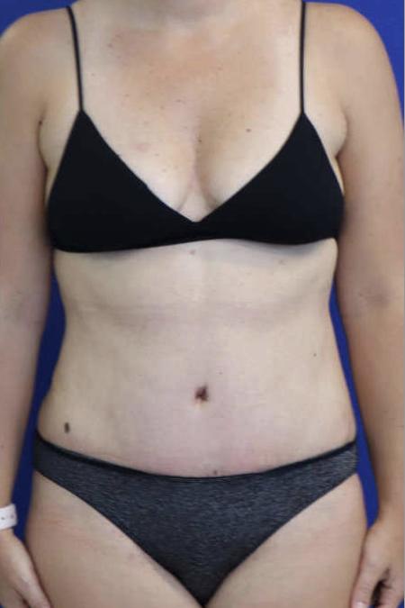 After Case #119306 - 41 year-old Patient | Tummy Tuck