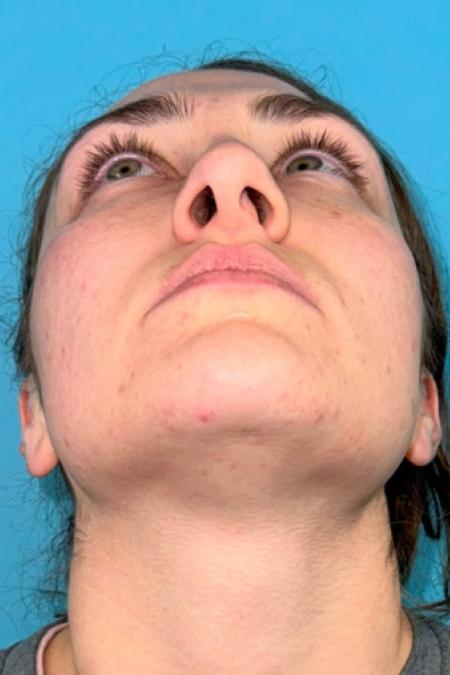 Before image 6 Case #119166 - Dream nose!