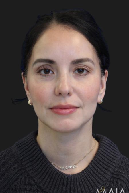 After image 2 Case #119231 - 49 year-old Patient | Mini Facelift 
