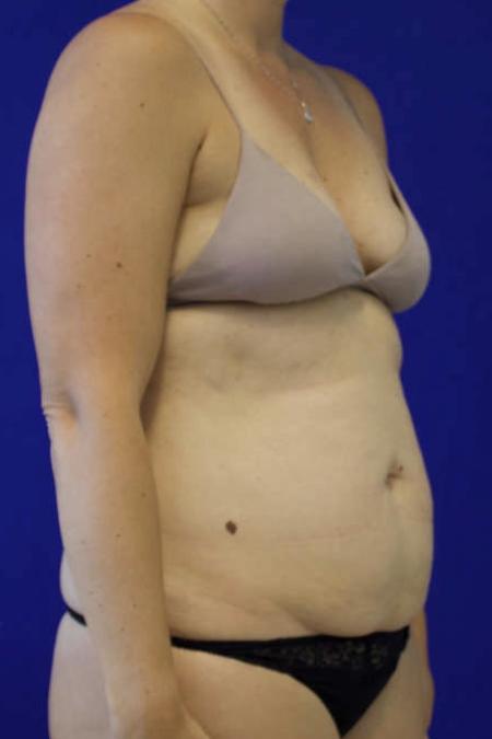 Before Case #119306 - 41 year-old Patient | Tummy Tuck