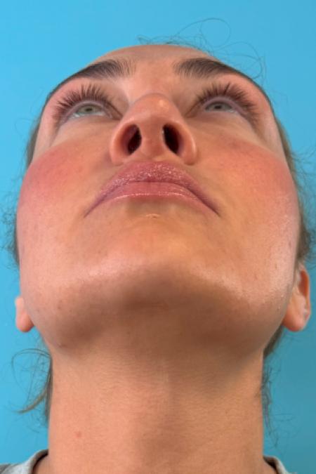 After image 6 Case #119166 - Dream nose!