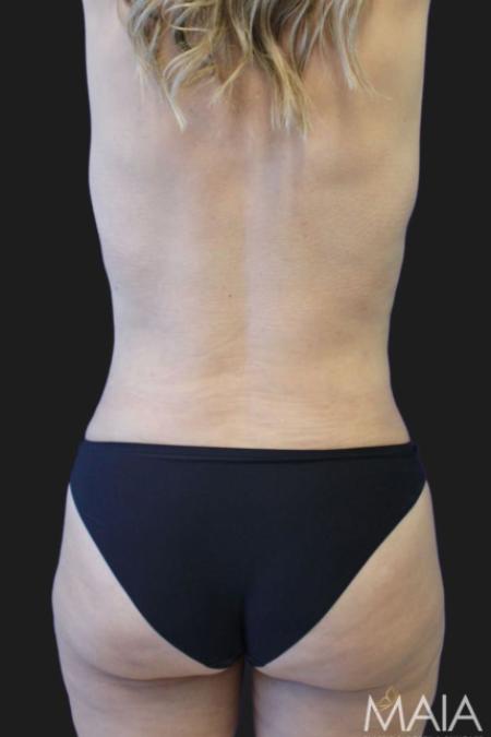 After image 4 Case #119276 - 48 year-old Patient | Tummy Tuck