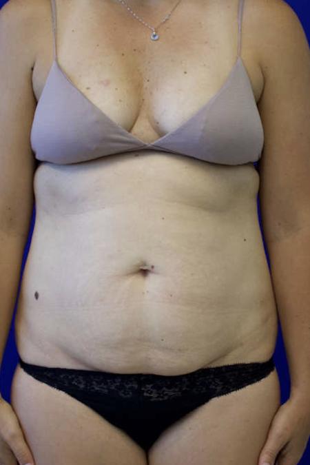 Before Case #119306 - 41 year-old Patient | Tummy Tuck