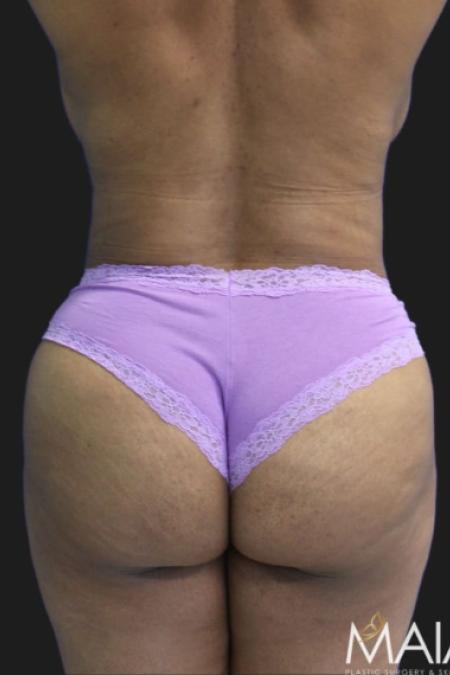After image 4 Case #119291 - 46 year-old Patient | Tummy Tuck