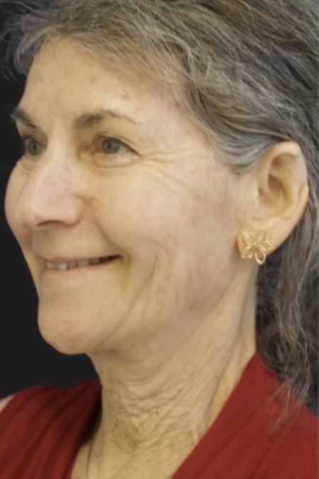 Before image 1 Case #119161 - 65 year-old Patient | Neck Lift