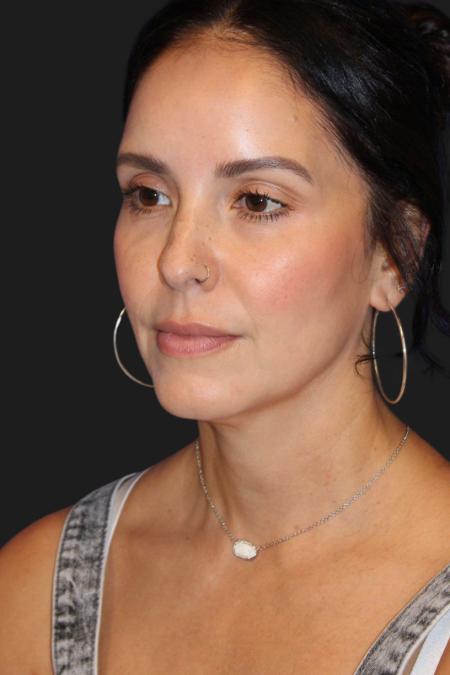 Before image 6 Case #119231 - 49 year-old Patient | Mini Facelift 