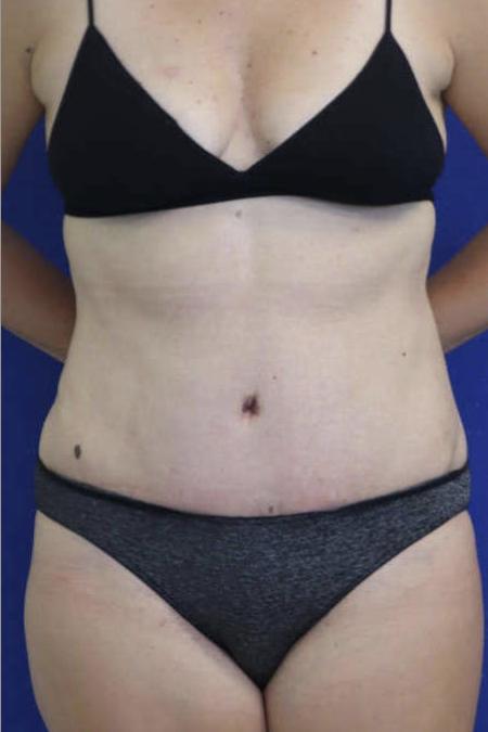 After Case #119306 - 41 year-old Patient | Tummy Tuck