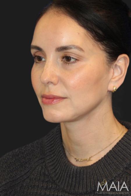 After image 6 Case #119231 - 49 year-old Patient | Mini Facelift 