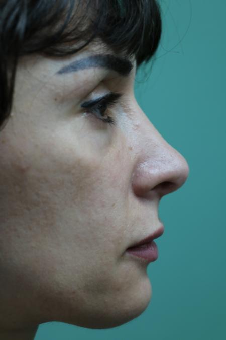 After image 4 Case #120921 - Midface rejuvination