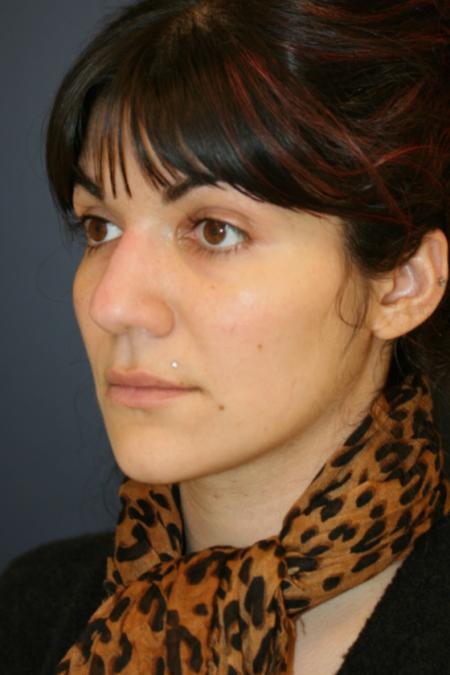 Before image 2 Case #121896 - Female Rhinoplasty