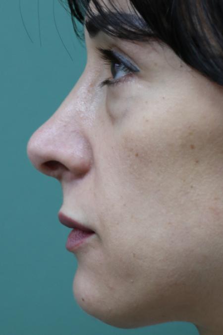 Before image 5 Case #120921 - Midface rejuvination