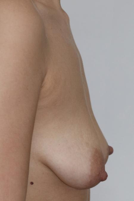 Before image 5 Case #120936 - Mastopexy Augmentation