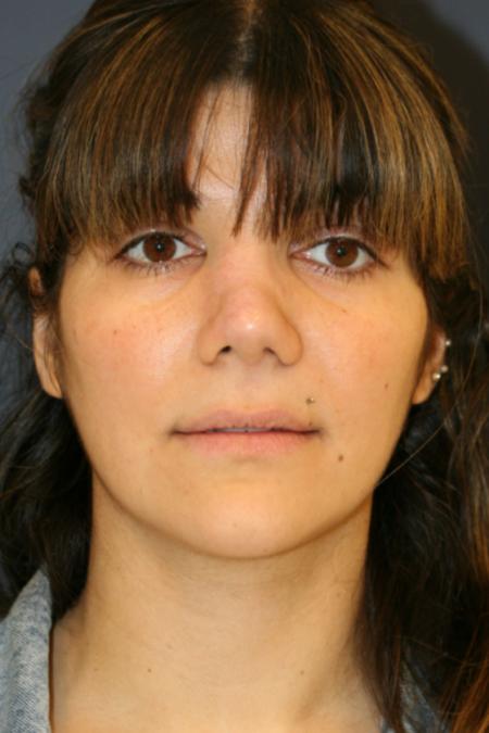 After image 1 Case #121896 - Female Rhinoplasty