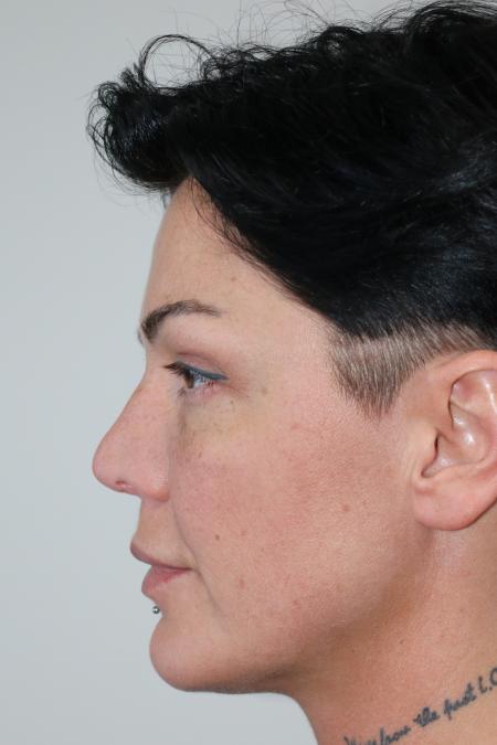 Before image 4 Case #121411 - Revision Rhinoplasty