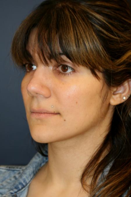 After image 2 Case #121896 - Female Rhinoplasty