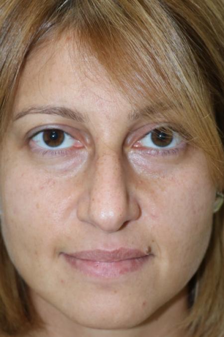 Before image 1 Case #120926 - Fat transfer to midface