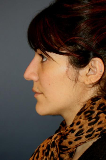 Before image 3 Case #121896 - Female Rhinoplasty