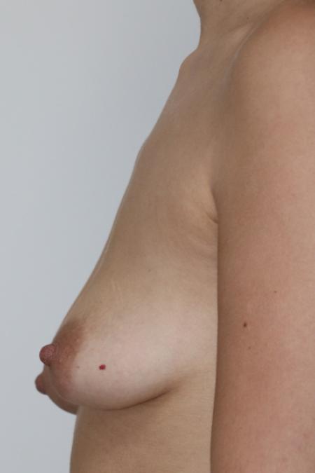 Before image 4 Case #120936 - Mastopexy Augmentation