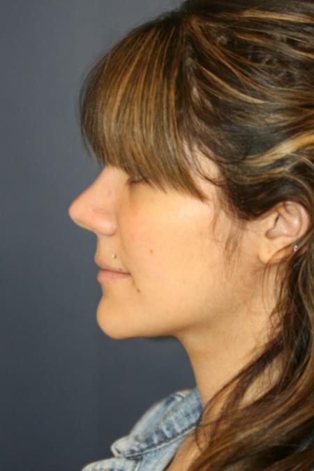 After image 3 Case #121896 - Female Rhinoplasty