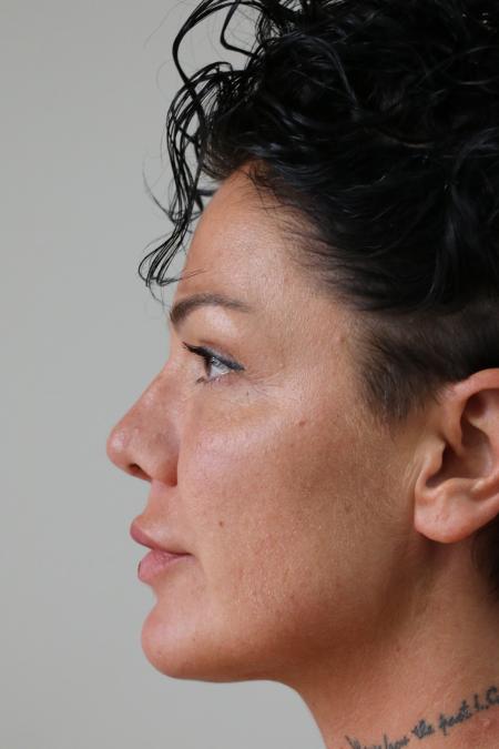 After image 4 Case #121411 - Revision Rhinoplasty