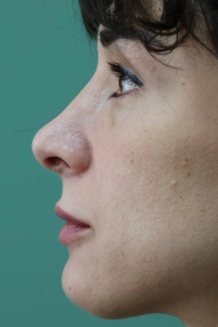 After image 5 Case #120921 - Midface rejuvination